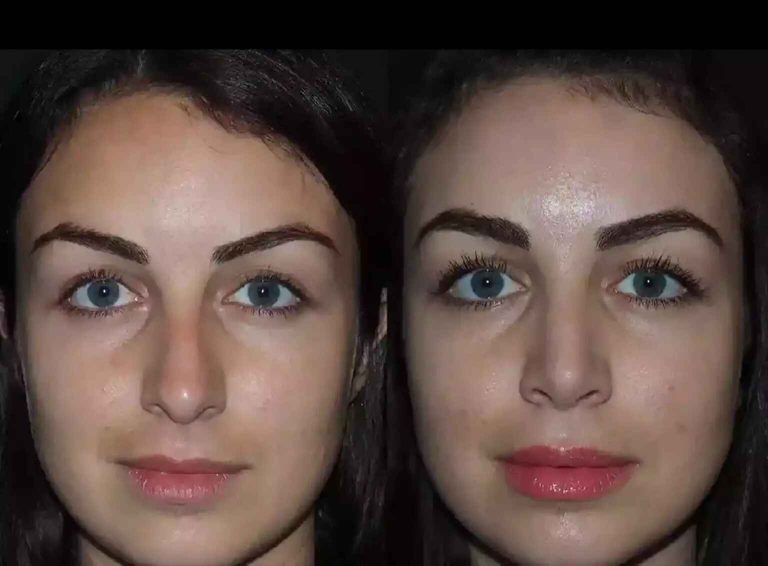 From Evaluation to Recovery: Septoplasty by Best Doctors in Dubai