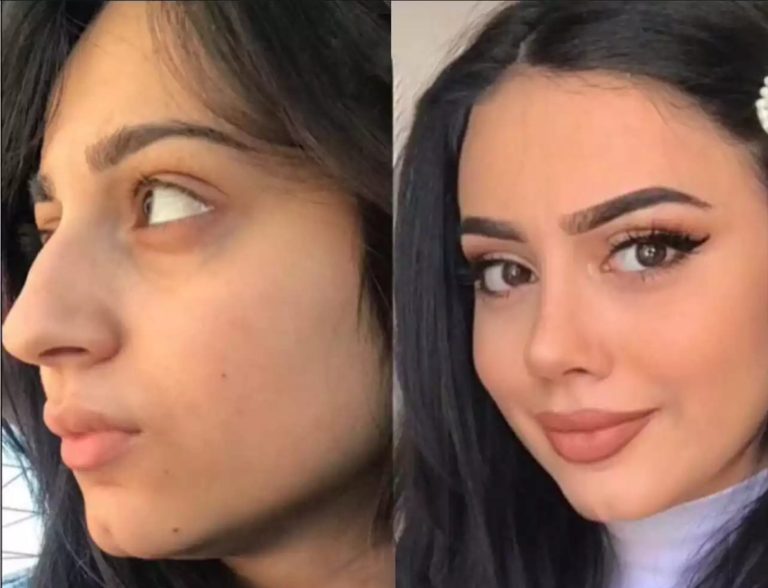 Do the Best Rhinoplasty Surgeons in Dubai Specialize in Revision Cases?