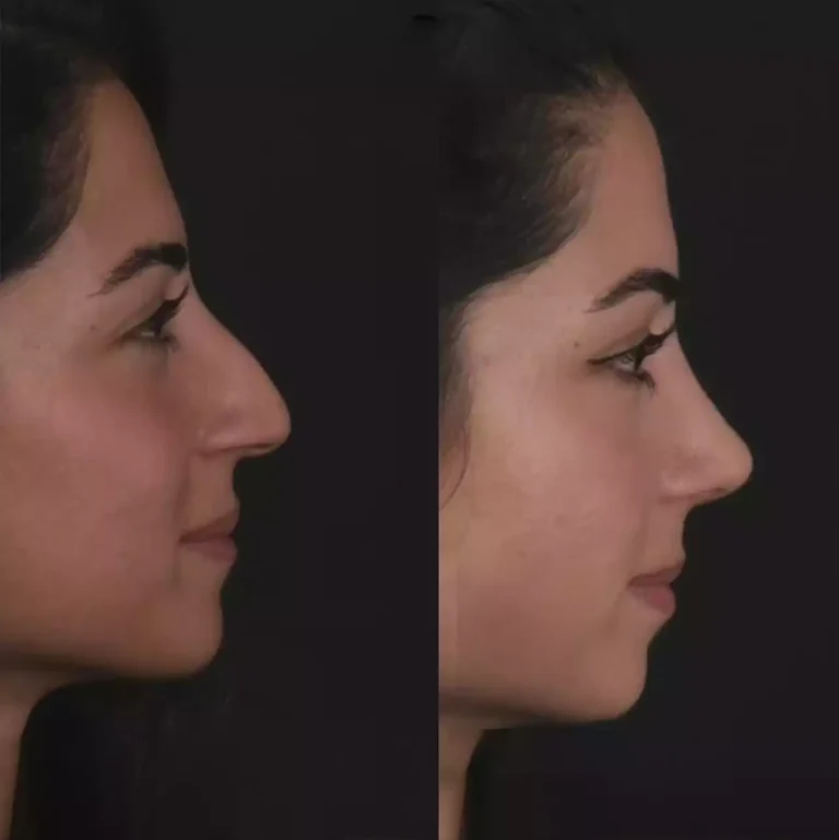 Achieve Clear Breathing with the Best Septoplasty Surgeons in Dubai