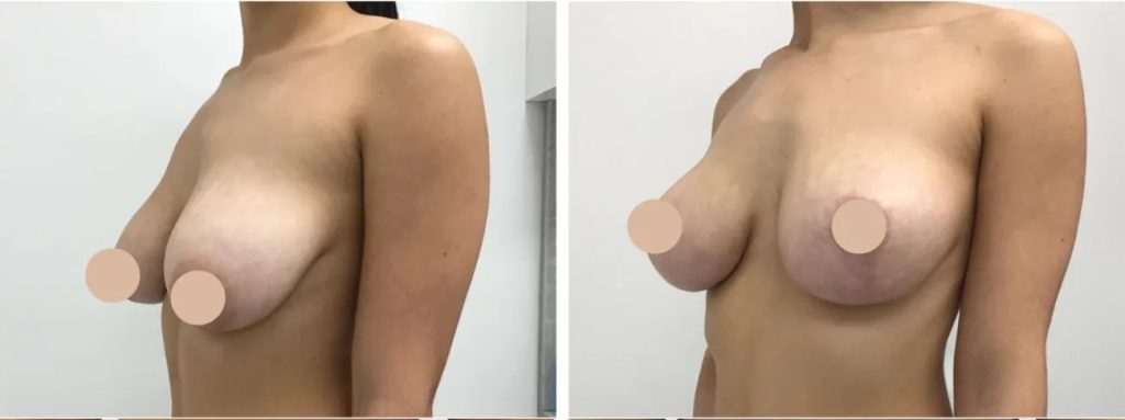 Complementary Treatments Offered Alongside Breast Reduction in Dubai