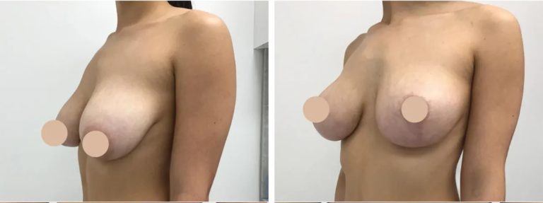 Complementary Treatments Offered Alongside Breast Reduction in Dubai
