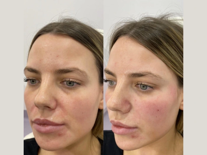 Best Plastic Surgeons in Dubai for PRP Treatment highlight its benefits for hair regrowth