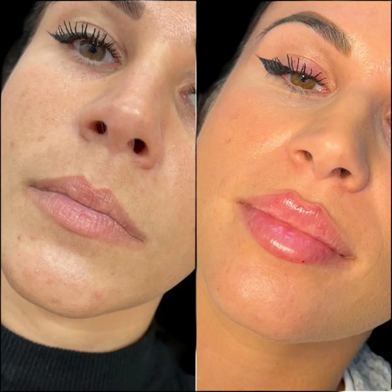 Safe and Stunning Results at the Best Aesthetic Clinic in Dubai for Fillers