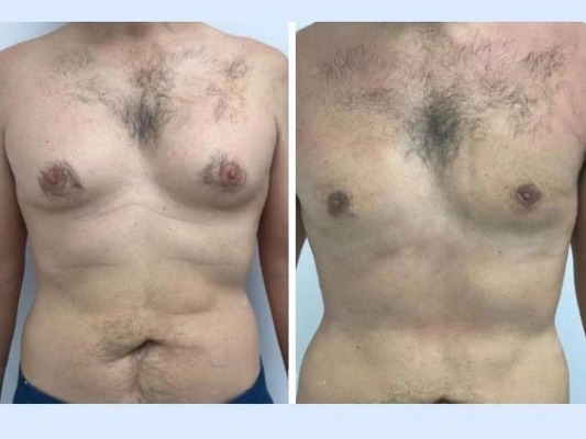 Detailed Breakdown of Each Stage of Gynecomastia in Dubai Surgery
