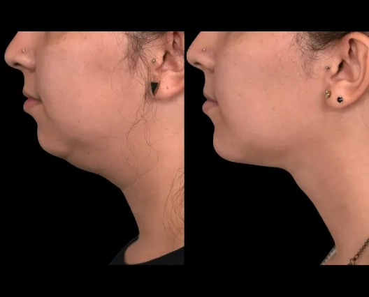 What age group is getting Double chin removal surgery in Dubai the most?