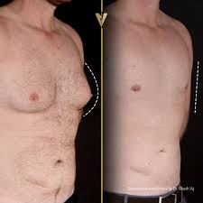 How to Choose the Right Surgeon for Gynecomastia in Dubai