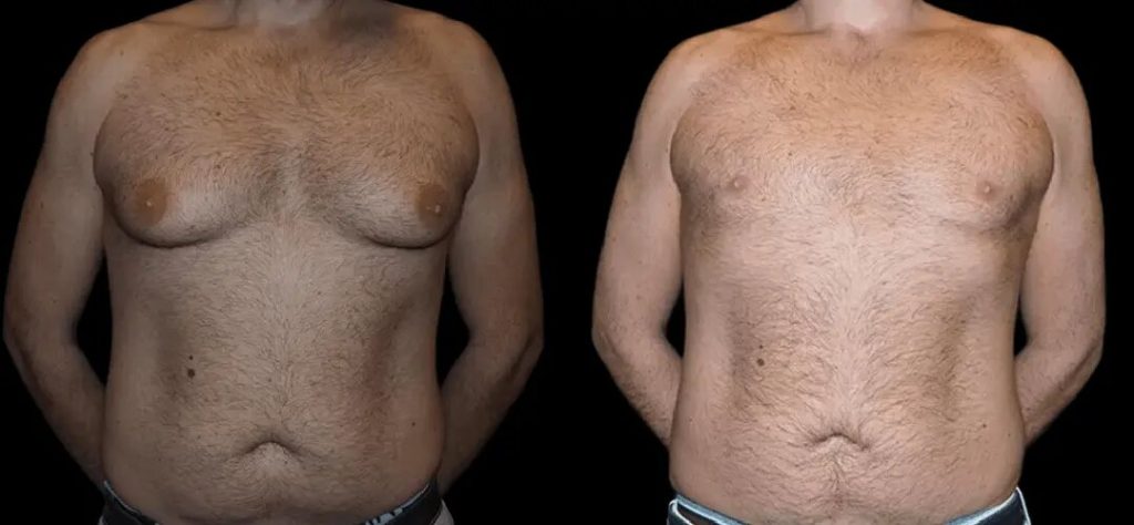 Latest Results Shared by the Best Gynecomastia Surgeon in dubai