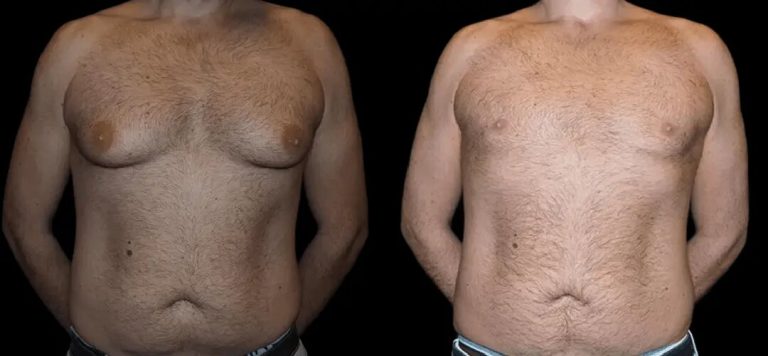 Latest Results Shared by the Best Gynecomastia Surgeon in dubai