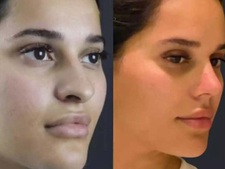 The Journey of Nose Surgery in Dubai: Consultation to Recovery