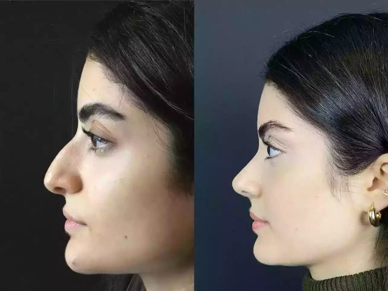Best Rhinoplasty Surgeon in Dubai: Balancing Aesthetics and Health