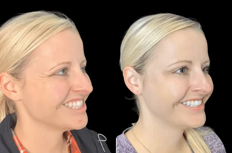 How the Best Aesthetic Clinics in Dubai Deliver Natural-Looking Botox Results