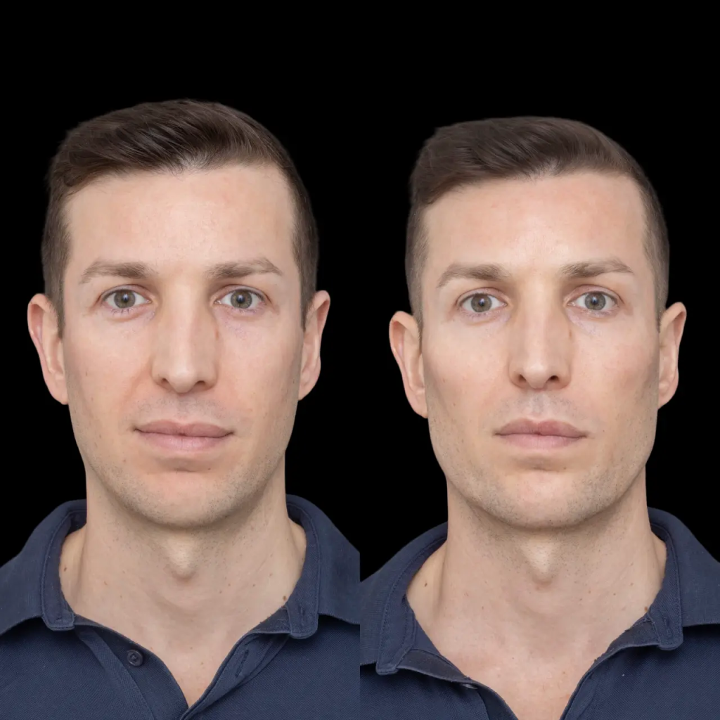 Before and After Jawline Fillers from the Best Plastic Surgeons in Dubai