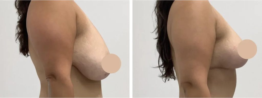 Why Breast Lift in Dubai is a Popular Choice Among Women