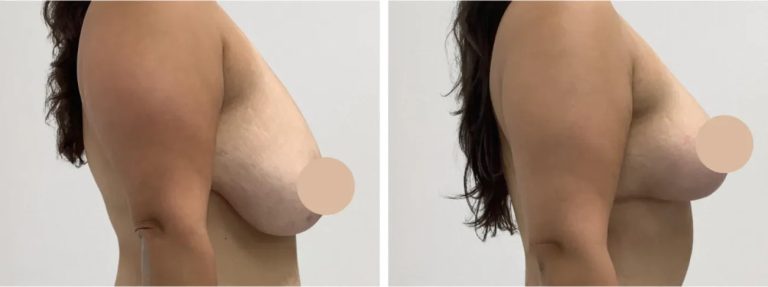 Why Breast Lift in Dubai is a Popular Choice Among Women