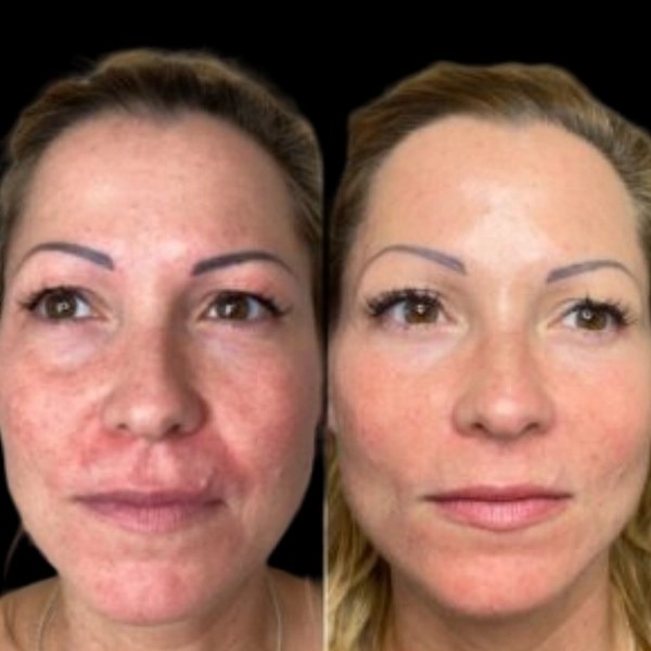 Awaken the Vitality with Profhilo Treatment in Dubai