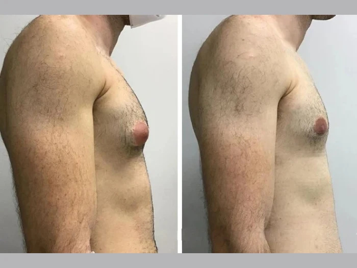 Gynecomastia Surgery in Dubai: Understanding the Healing Process