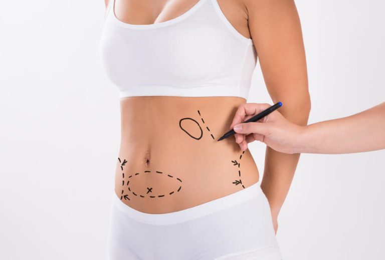 Full Body Liposuction Surgery in Dubai What Patients Need to Know