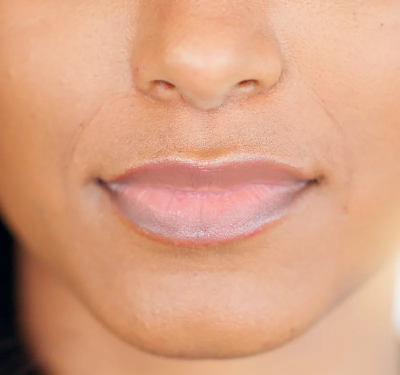 Top Benefits of Choosing Lip Pigmentation Treatment