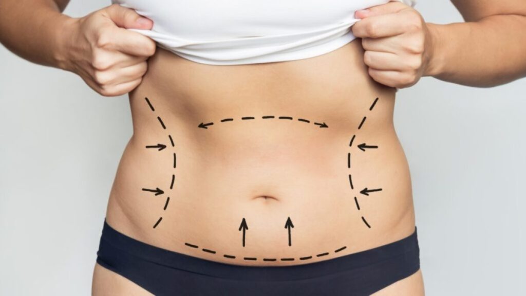 Best Liposuction Surgeon in Dubai for Flawless and Sculpted Body