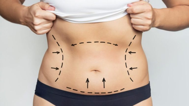 Best Liposuction Surgeon in Dubai for Flawless and Sculpted Body