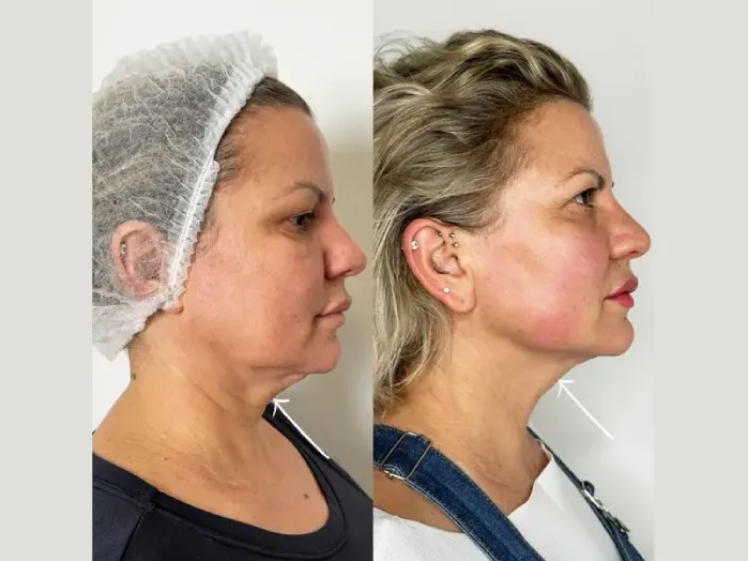 Endolift Treatment in Dubai: Non-Surgical Jawline Perfection