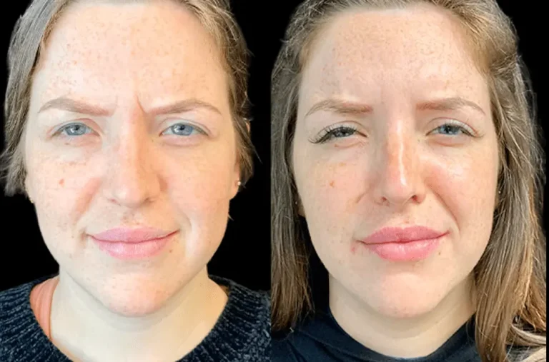 Discover the Best Doctors in Dubai for Botox and Skin Rejuvenation