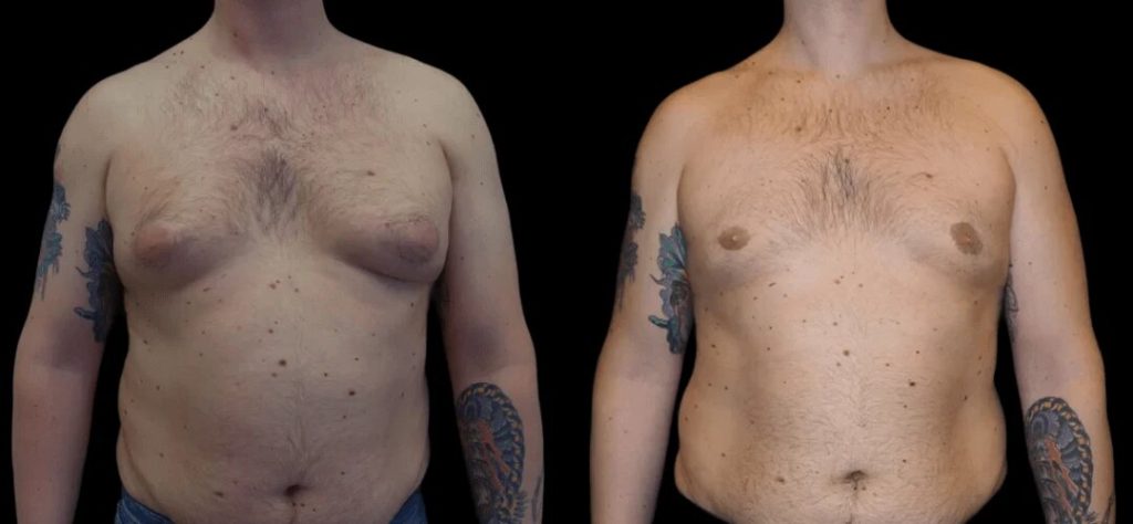 Best Gynecomastia Doctors in Dubai Specialists for Men’s Chest Reduction Surgery