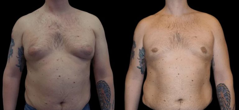 Best Gynecomastia Doctors in Dubai Specialists for Men’s Chest Reduction Surgery