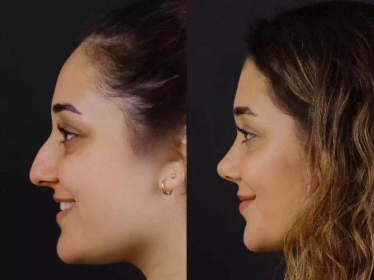 How Nose Deviated Septum Surgery in Dubai Improves Daily Breathing Comfort