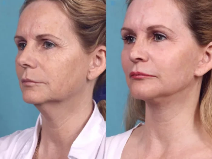 Chemical Peel Treatments in Dubai: The Secret to Glass-Like, Flawless Skin