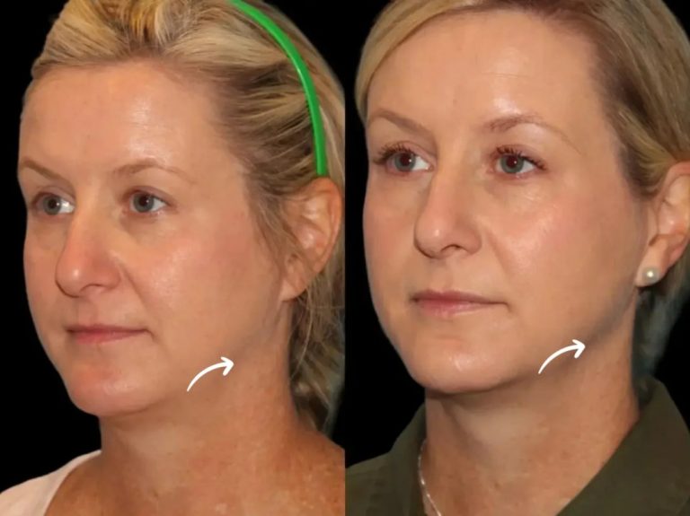 Mastering Sculptra Techniques with the Best Plastic Surgeon in Dubai