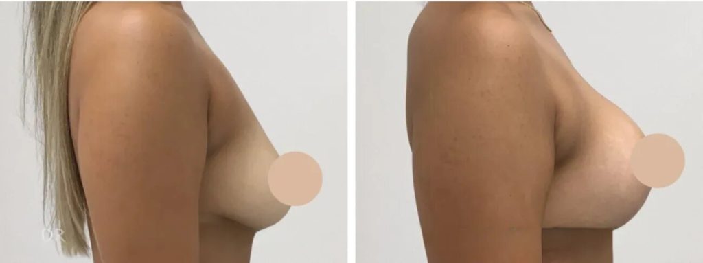 Breast Lift in Dubai Beauty Confidence and Modern Care