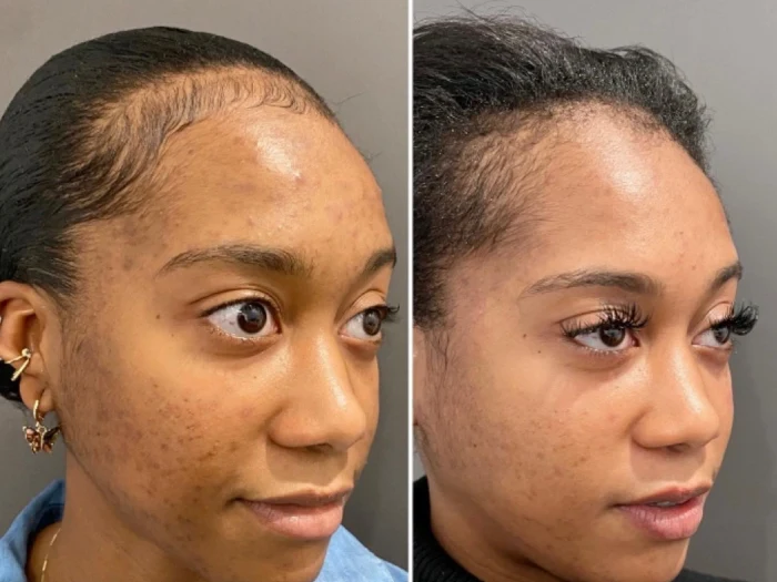 How Often Should You Get Chemical Peel Treatment in Dubai for Lasting Results?