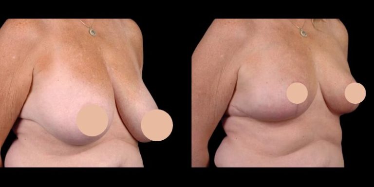 Quick Facts You Must Know about Breast Reduction in Dubai
