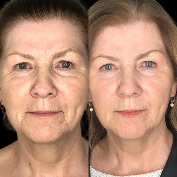 Smooth Profhilo Perfection with Best Plastic Surgeon in dubai