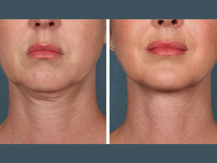 Best Plastic Surgeon in Dubai PRP Treatment for Wrinkle Reduction