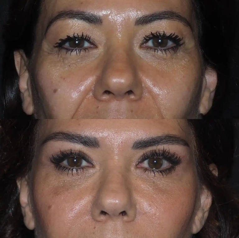 Eye bag removal in Dubai: Dubai vs Turkey