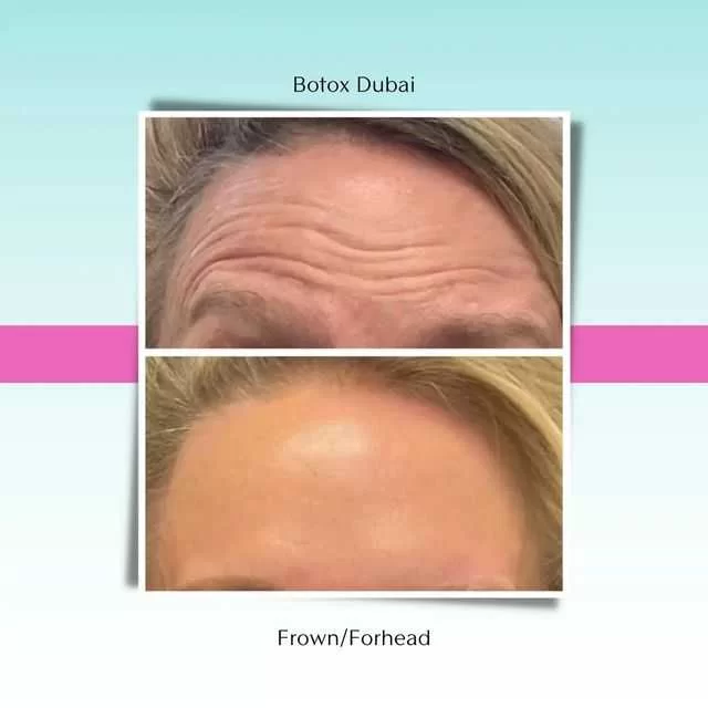 Look Younger with Botox in Dubai