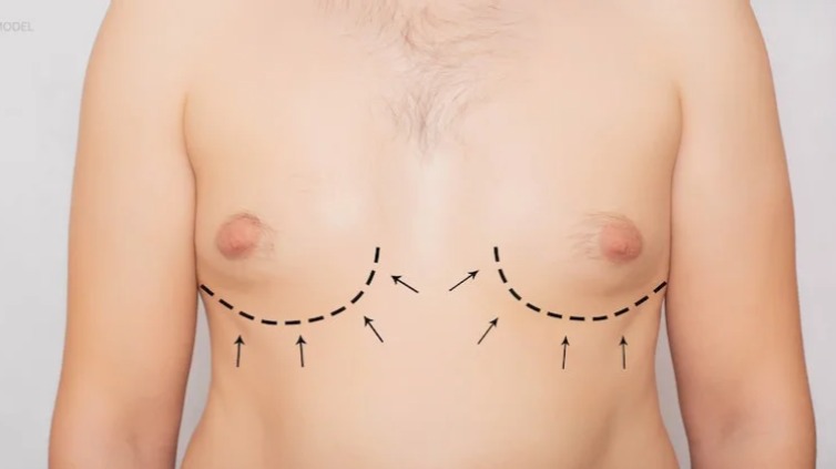 Achieve a Masculine Chest with Gynecomastia in Dubai