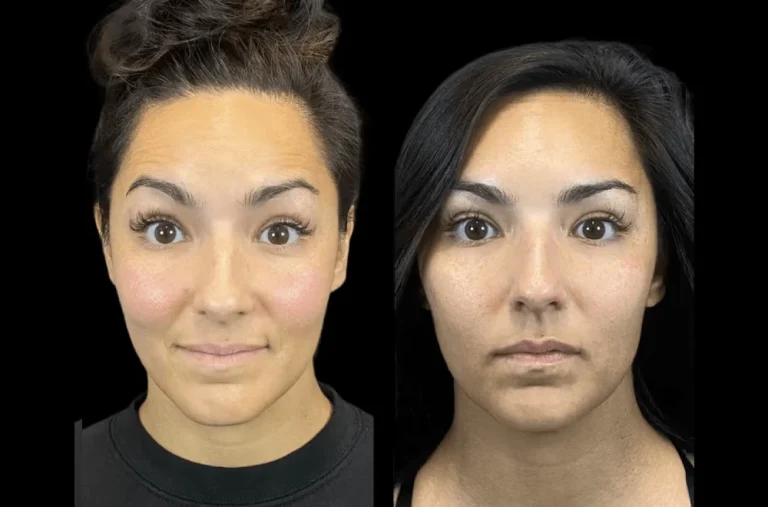 The Rise of Preventative Botox Treatment in Dubai Among Millennials