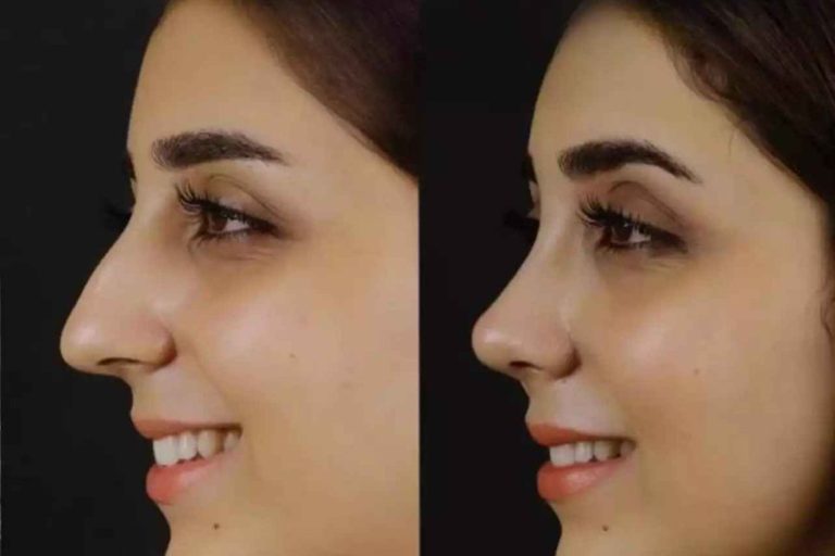 Nose Deviated Septum Surgery in Dubai: Restoring Natural Airflow