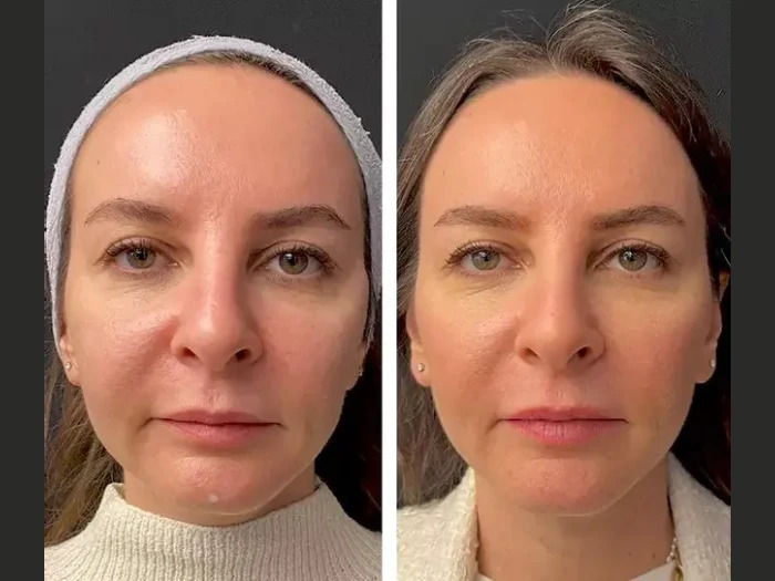 Top Benefits of Visiting the Best Plastic Surgeon in dubai for Mesotherapy Treatments