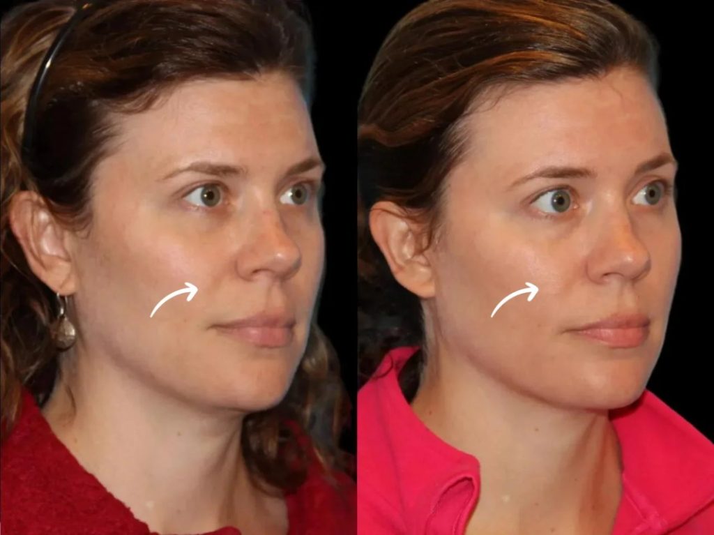 Sculptra in Dubai for Jawline Aging: A Complete Guide