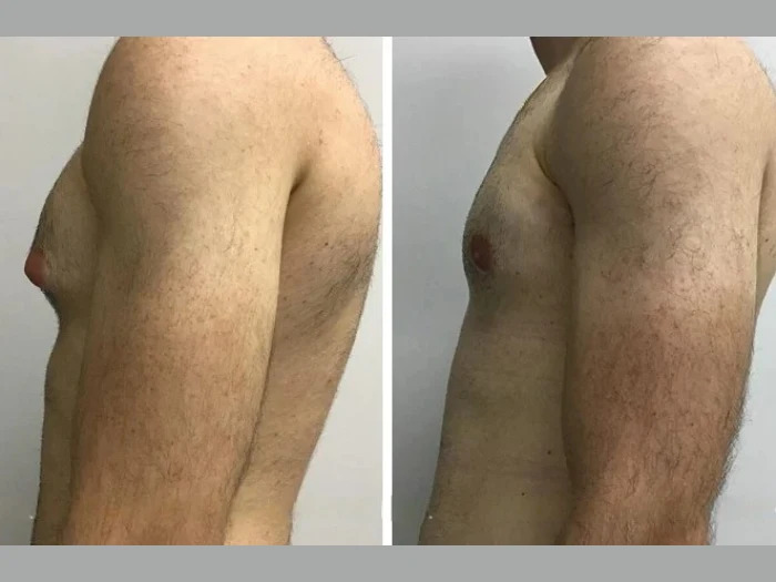 Gynecomastia Surgery in dubai for a Clean, Masculine Contour