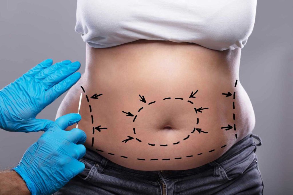 Tummy Tuck Dubai: Natural-Looking Results and Confidence Boost