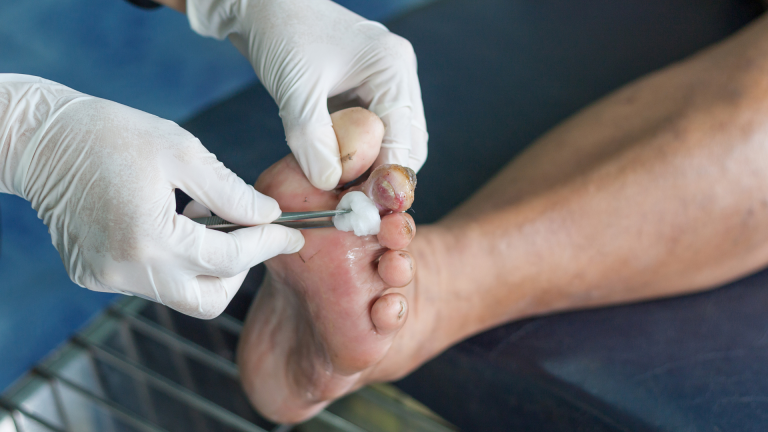 Expert Mobile Diabetes & Foot Care Services in Edmonton