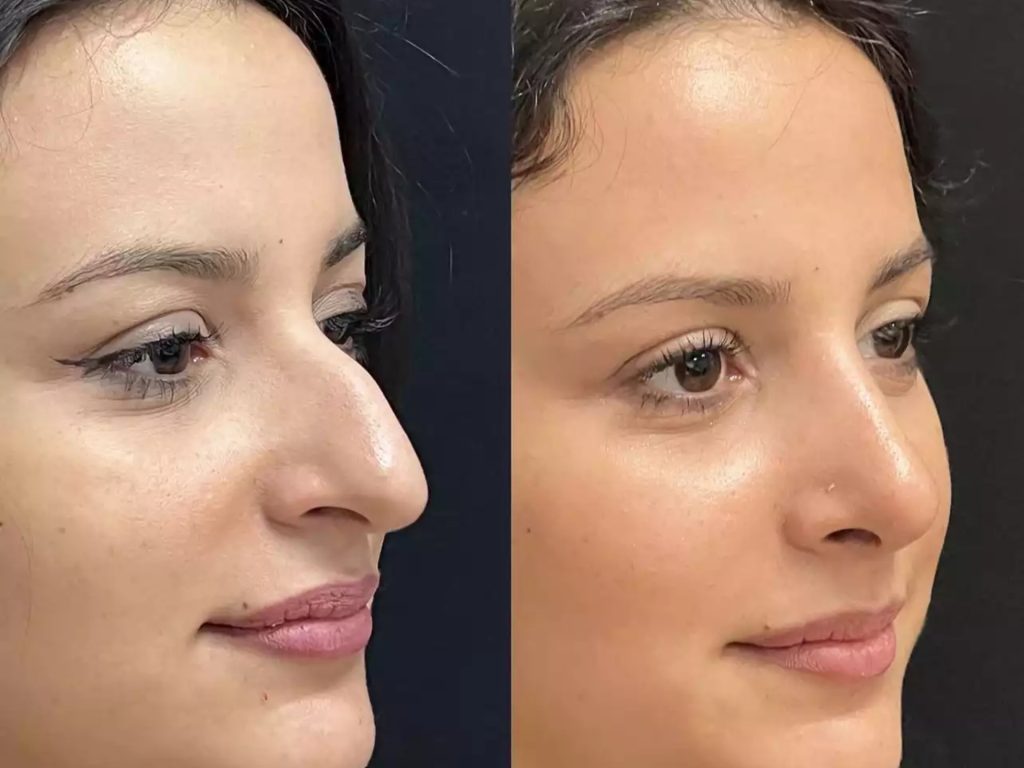 Top Rhinoplasty Tips from Best Doctors in Dubai