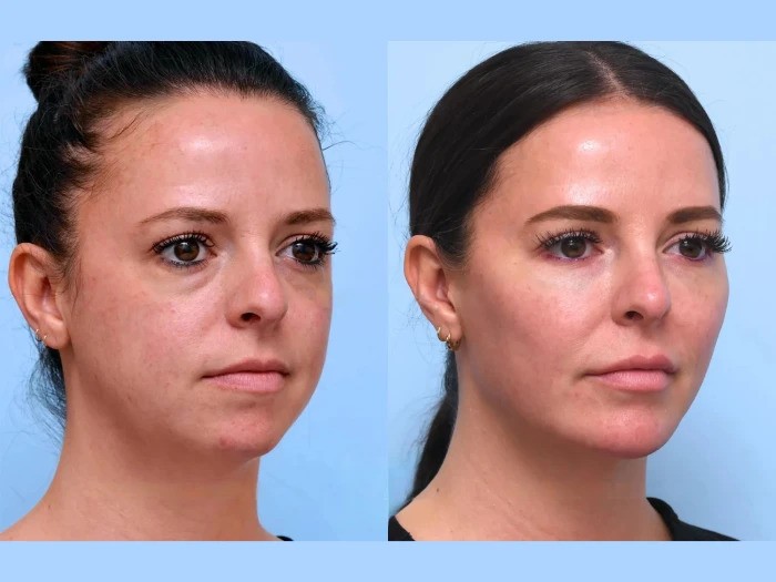 Non-Surgical Thread Lift: Best Doctors in Dubai for Visible, Long-Lasting Results