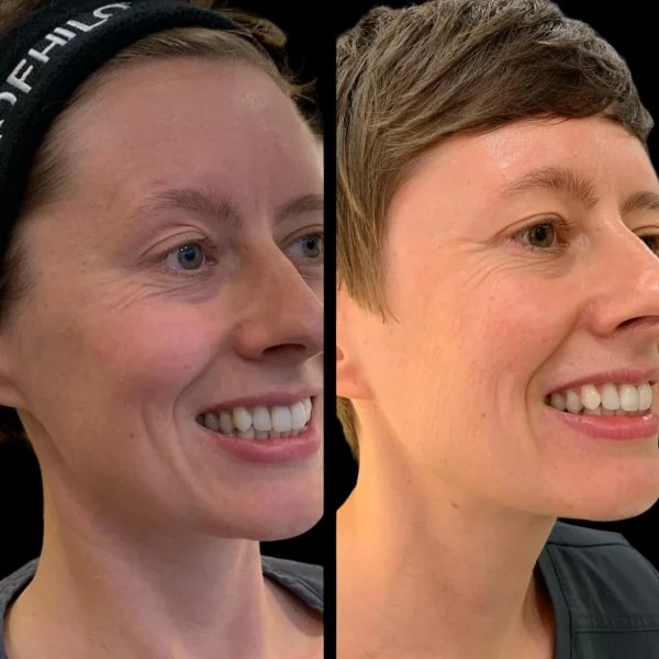 Profhilo in Dubai for Advanced Skin Bio-Remodeling