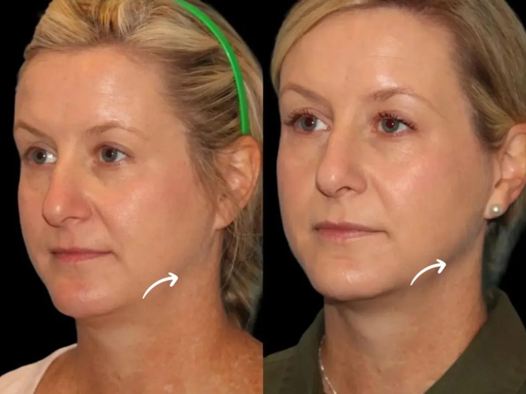 Sculptra Popularity Tips by Best Doctors in Dubai Trend